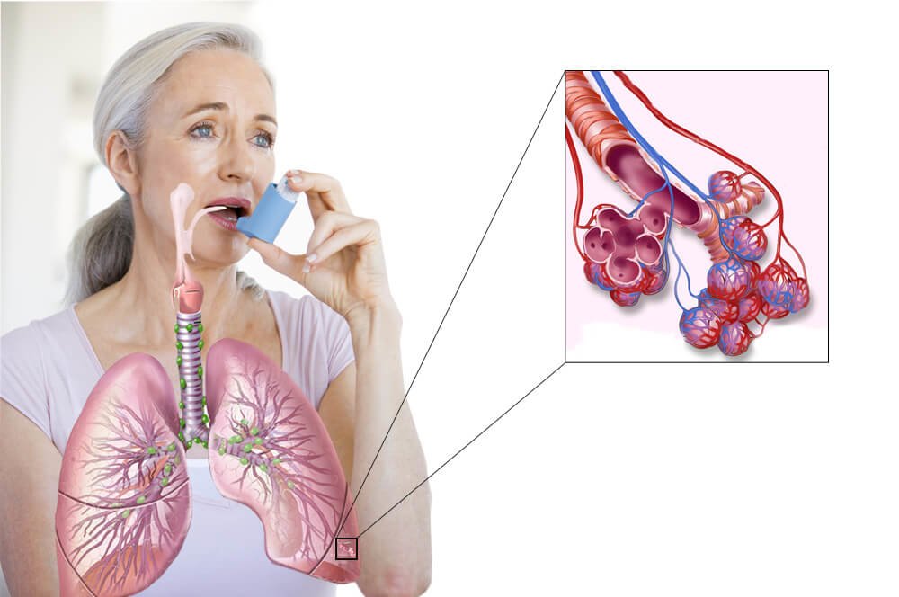 kaalulangus ravib astma