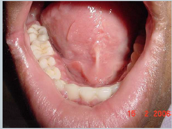hammaste abstsess kaalulangus
