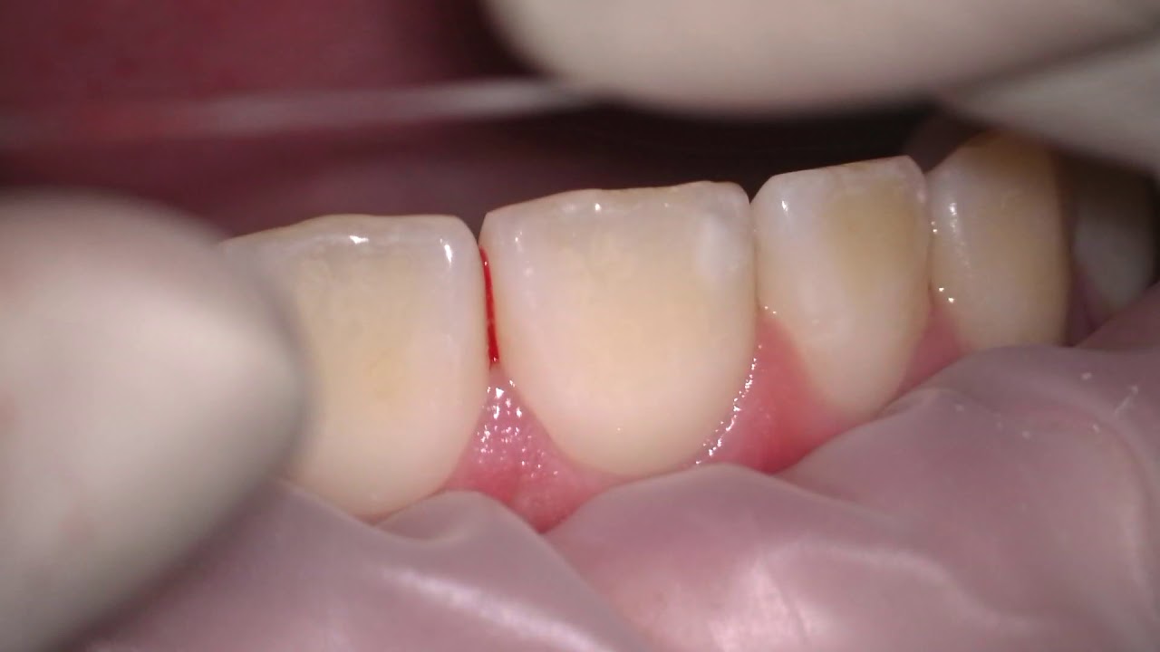 hammaste abstsess kaalulangus